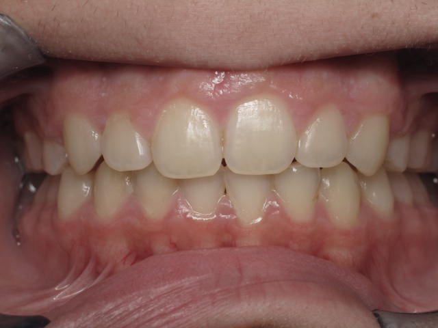 Orthodontic Treatment Case Study