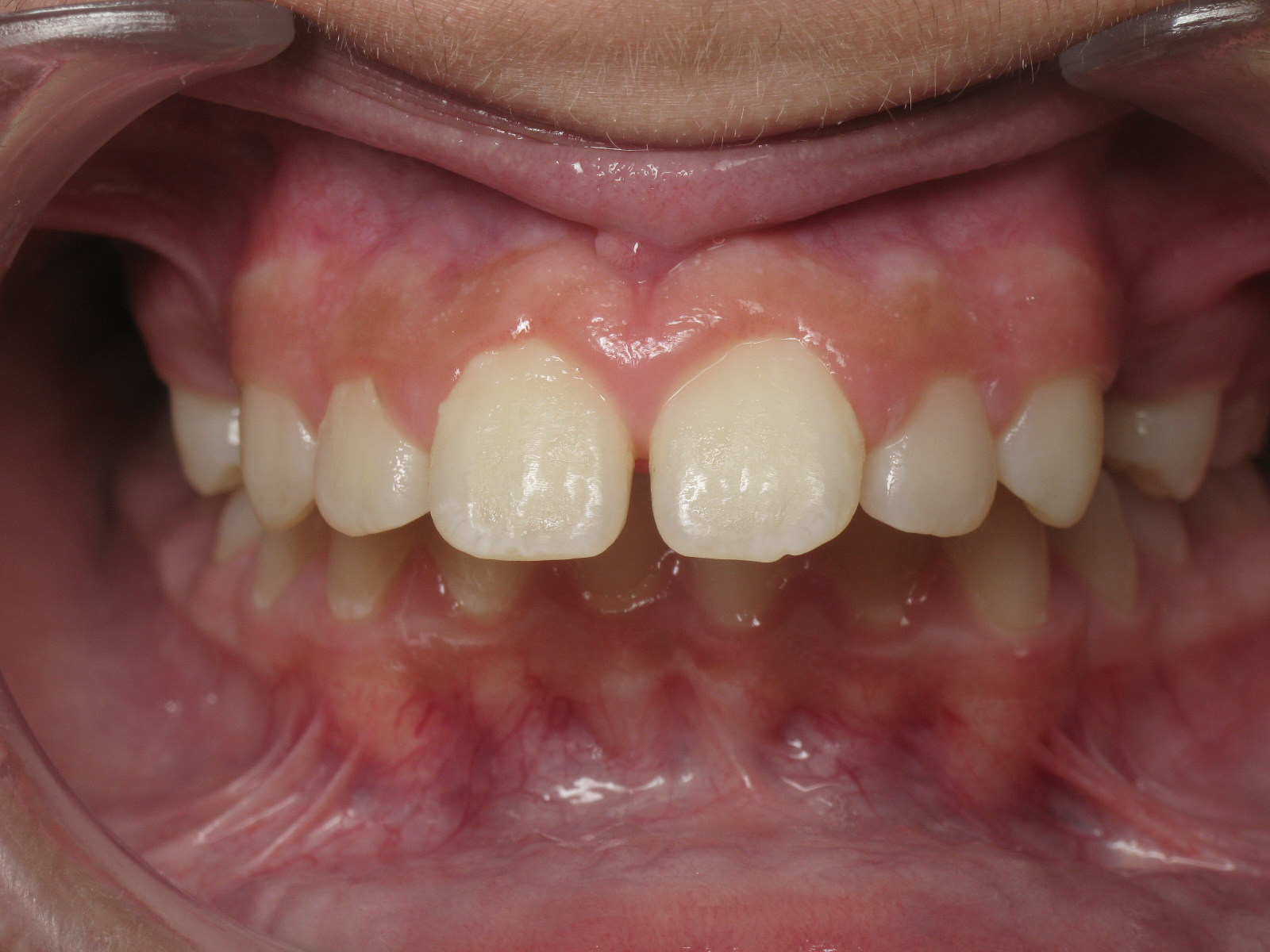 Orthodontic Treatment Case Study