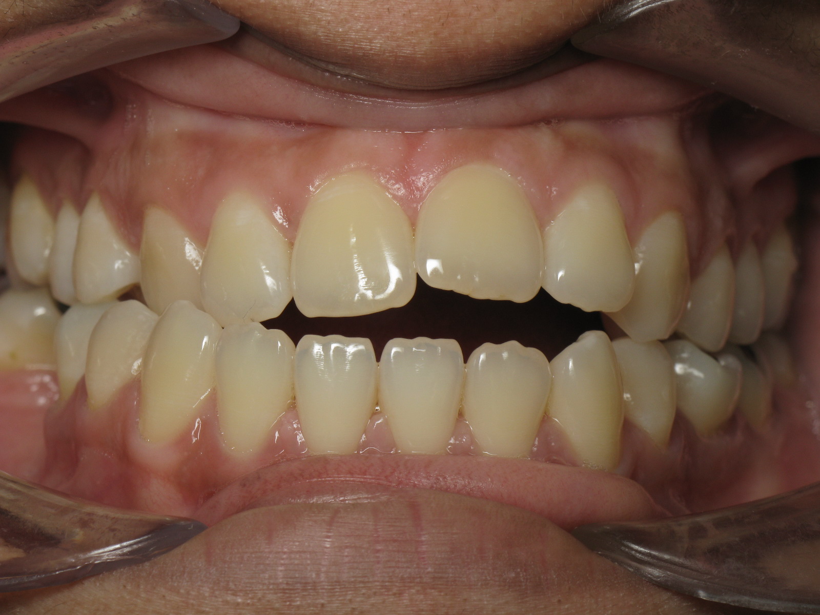 Orthodontic Treatment Case Study