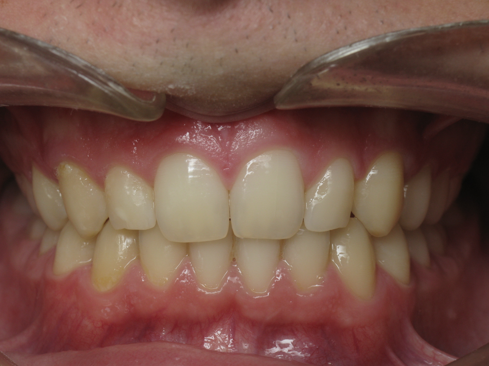 Orthodontic Treatment Case Study