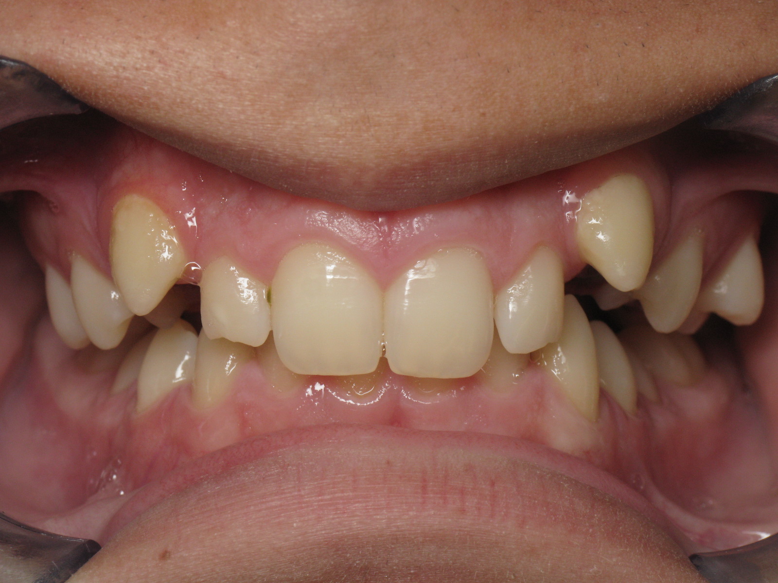 Orthodontic Treatment Case Study